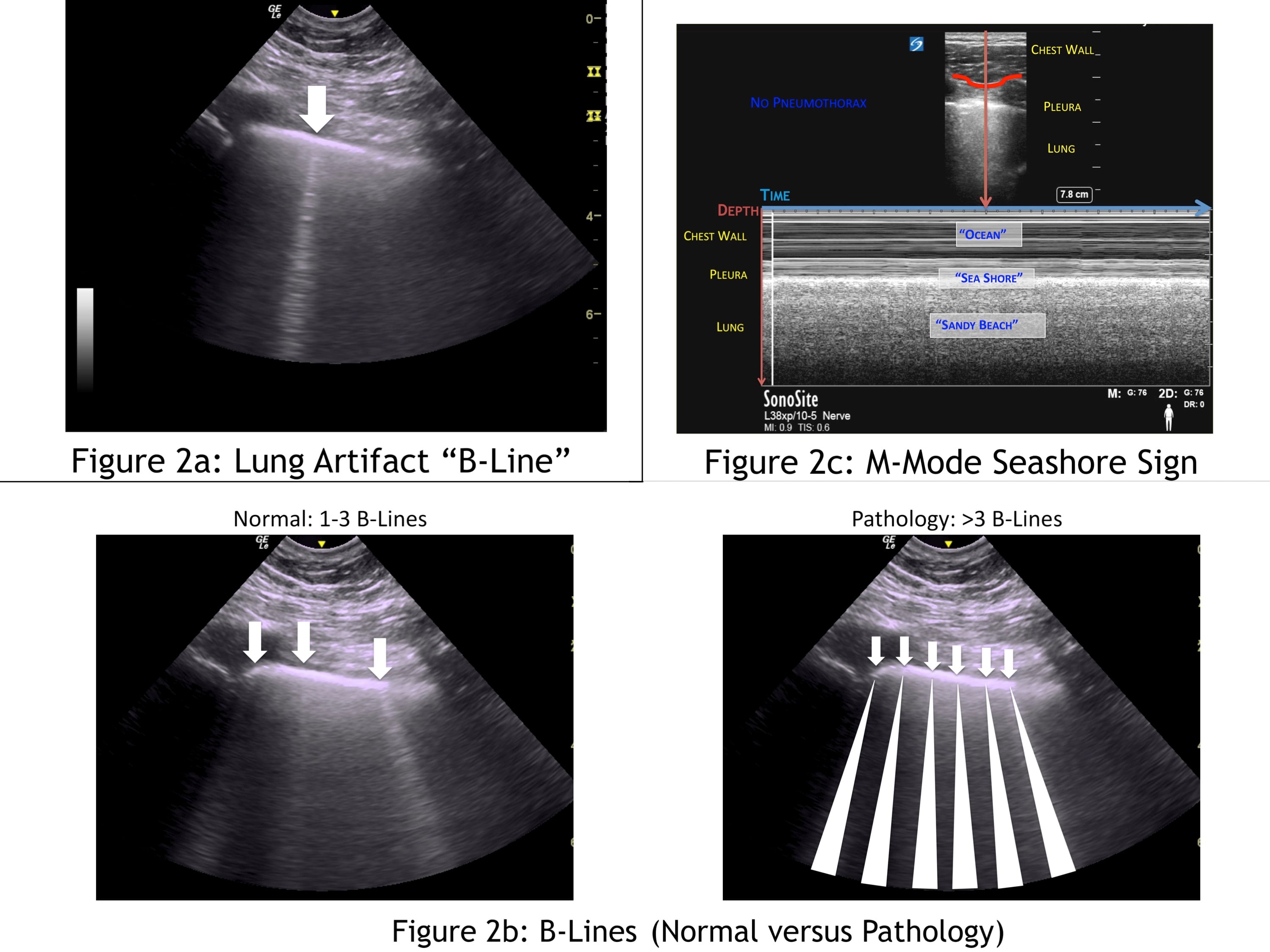 Lung artifact b line