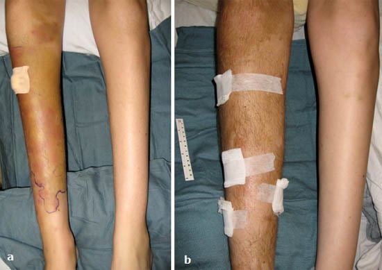complex-regional-pain-syndrome-allodynia-vasomotor-changes