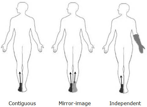 complex-regional-pain-syndrome-three-types-of-spread