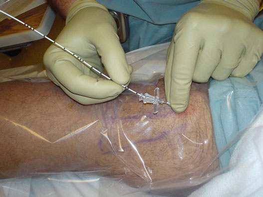 continuous-peripheral-nerve-blocks-stimulating-lead