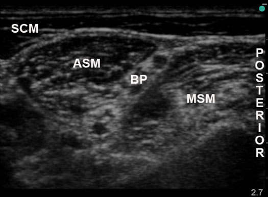 continuous-peripheral-nerve-blocks-target-nerve