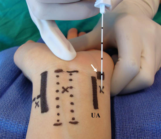 distal-peripheral-nerve-blocks-ulnar-nerve-blockade-wrist