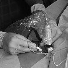 Fermoral_nerve_block cropped