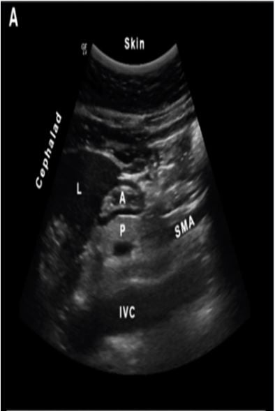 Sagittal scan of an empty antrum