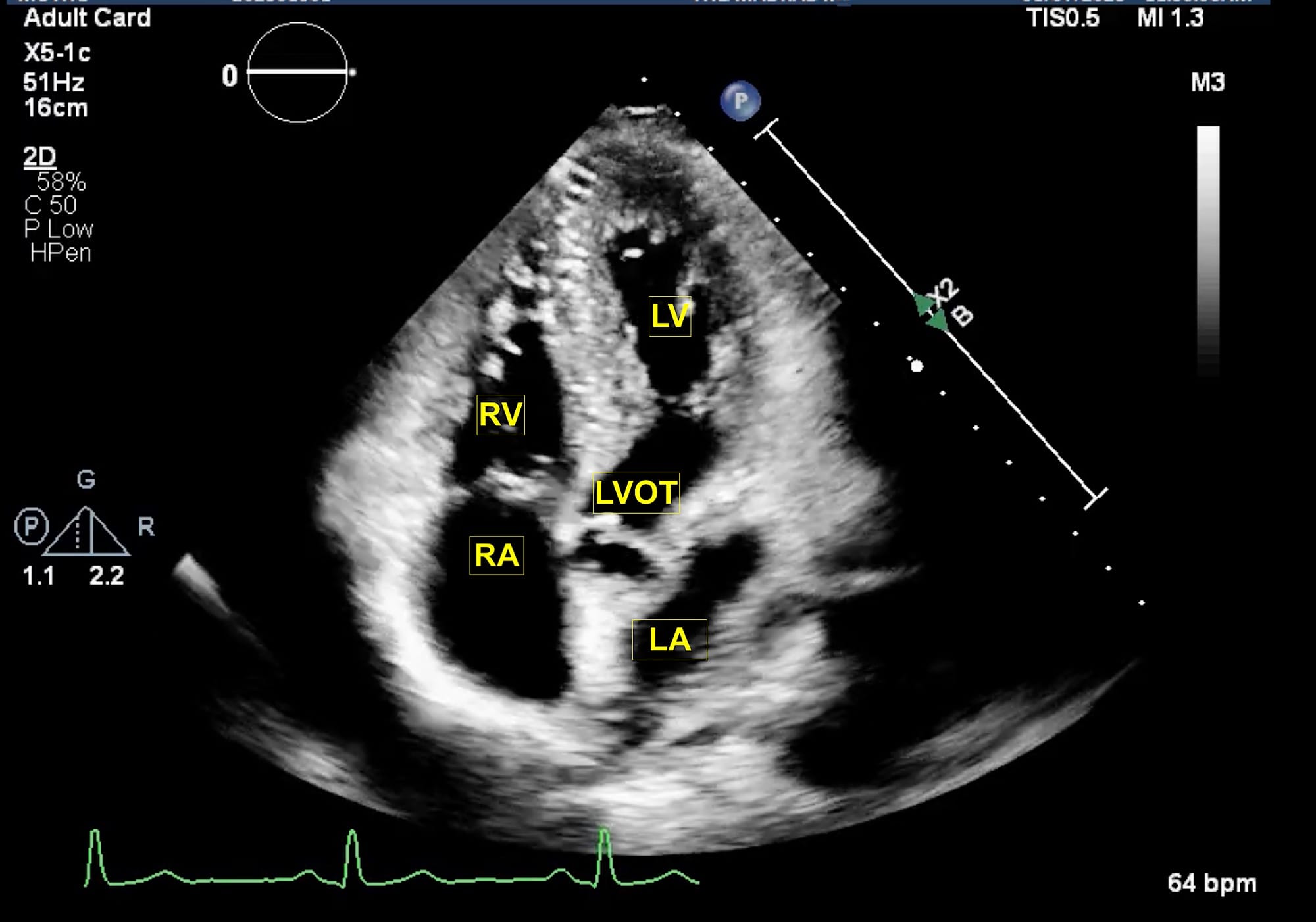Figure 1 Apical 5 C Modified