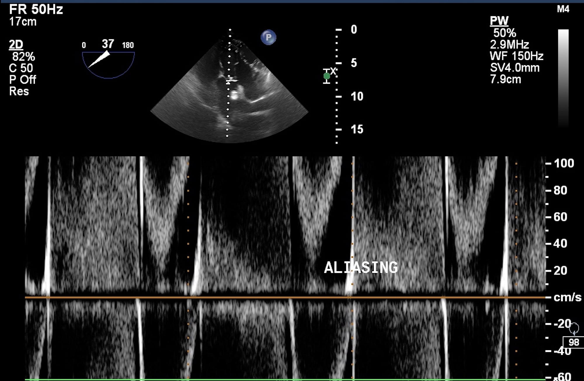 Figure 10 Alaising Artifact