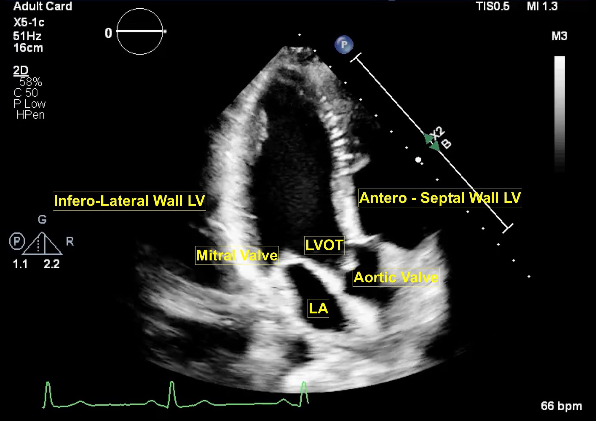 Figure 3 Aotic Long Axis