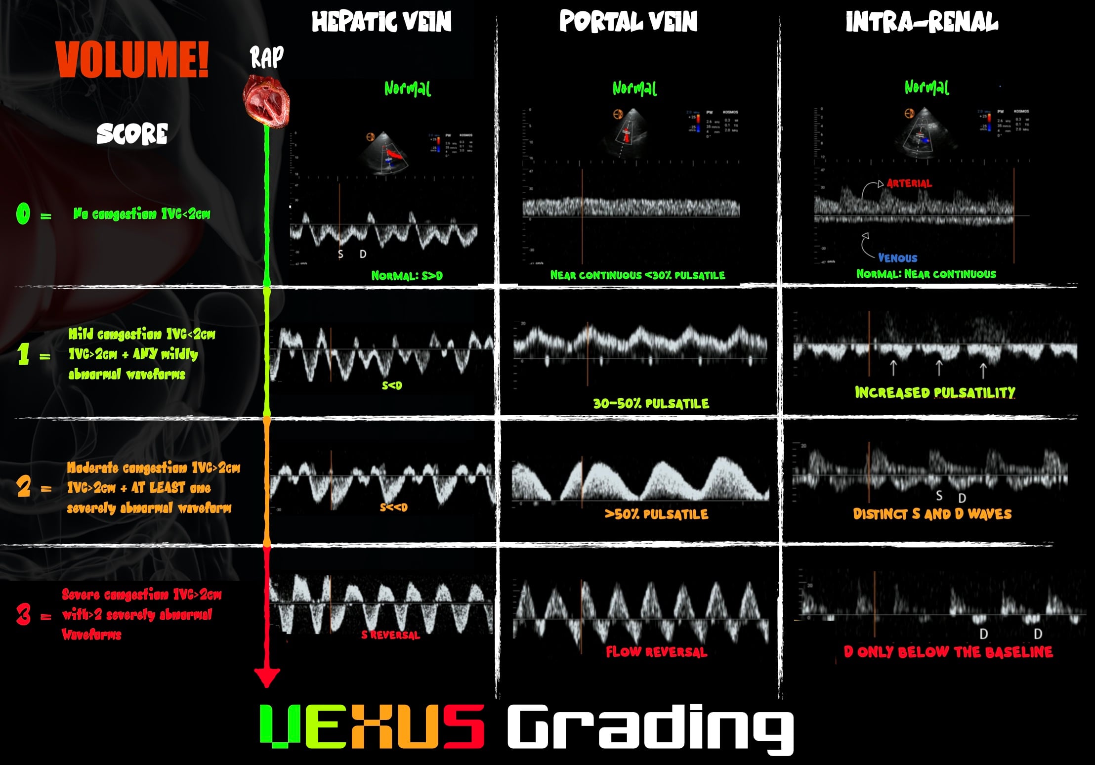 Infographic demonstrating VExUS grading