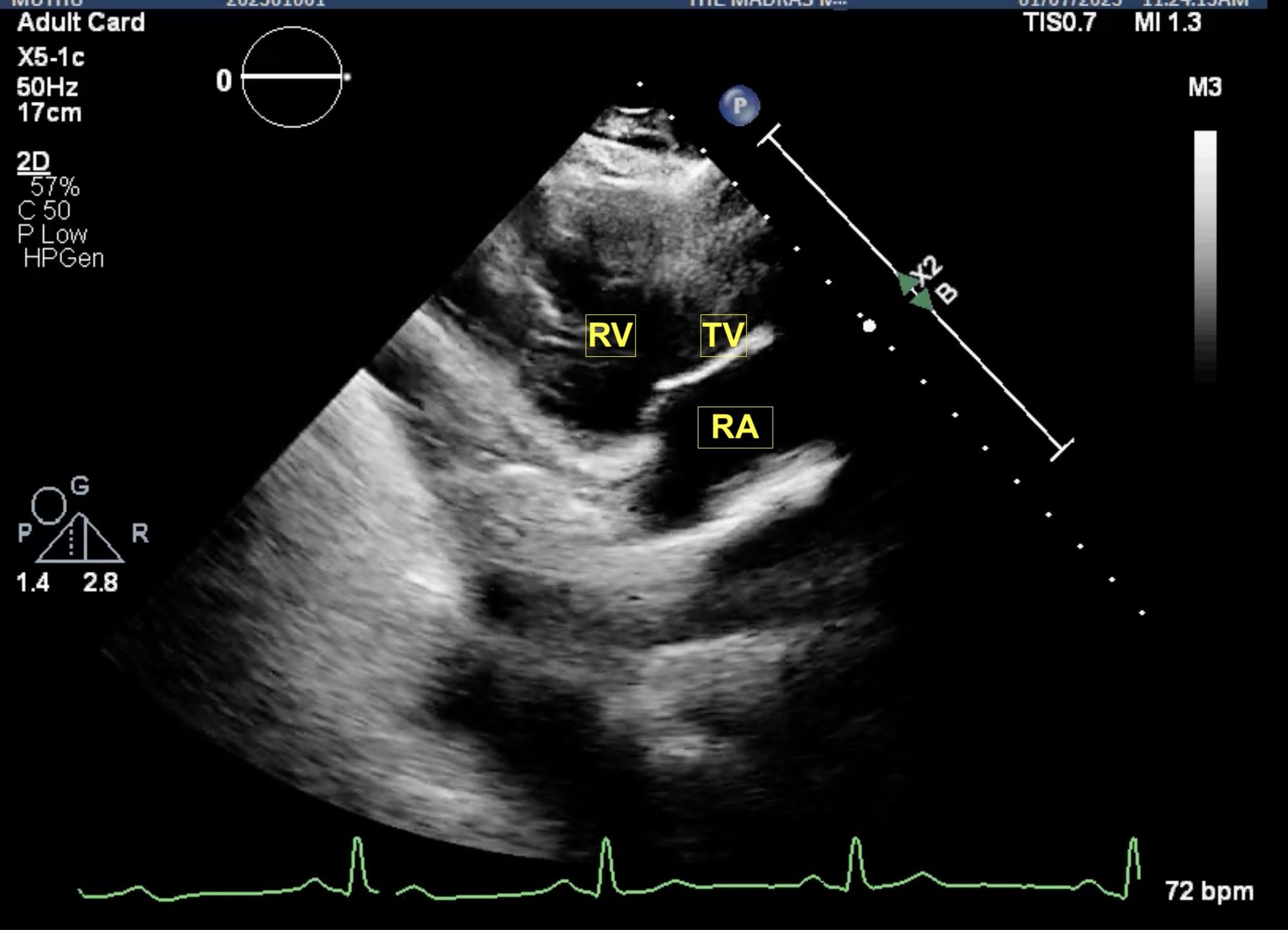 Figure 4 RV Inflow View