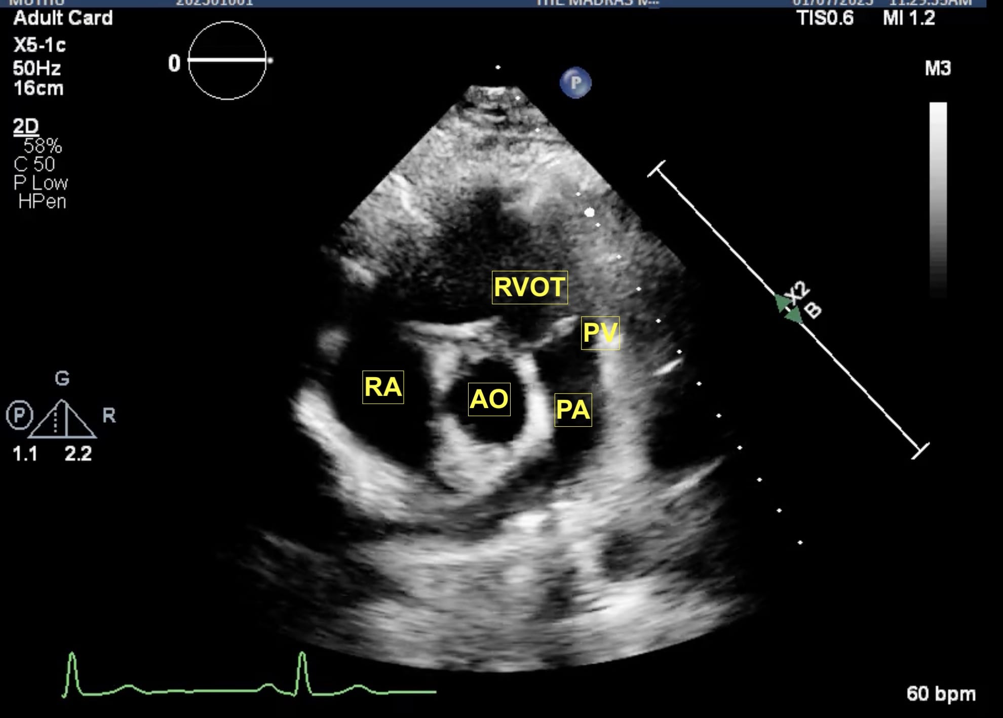 Figure 5 RV Outflow View
