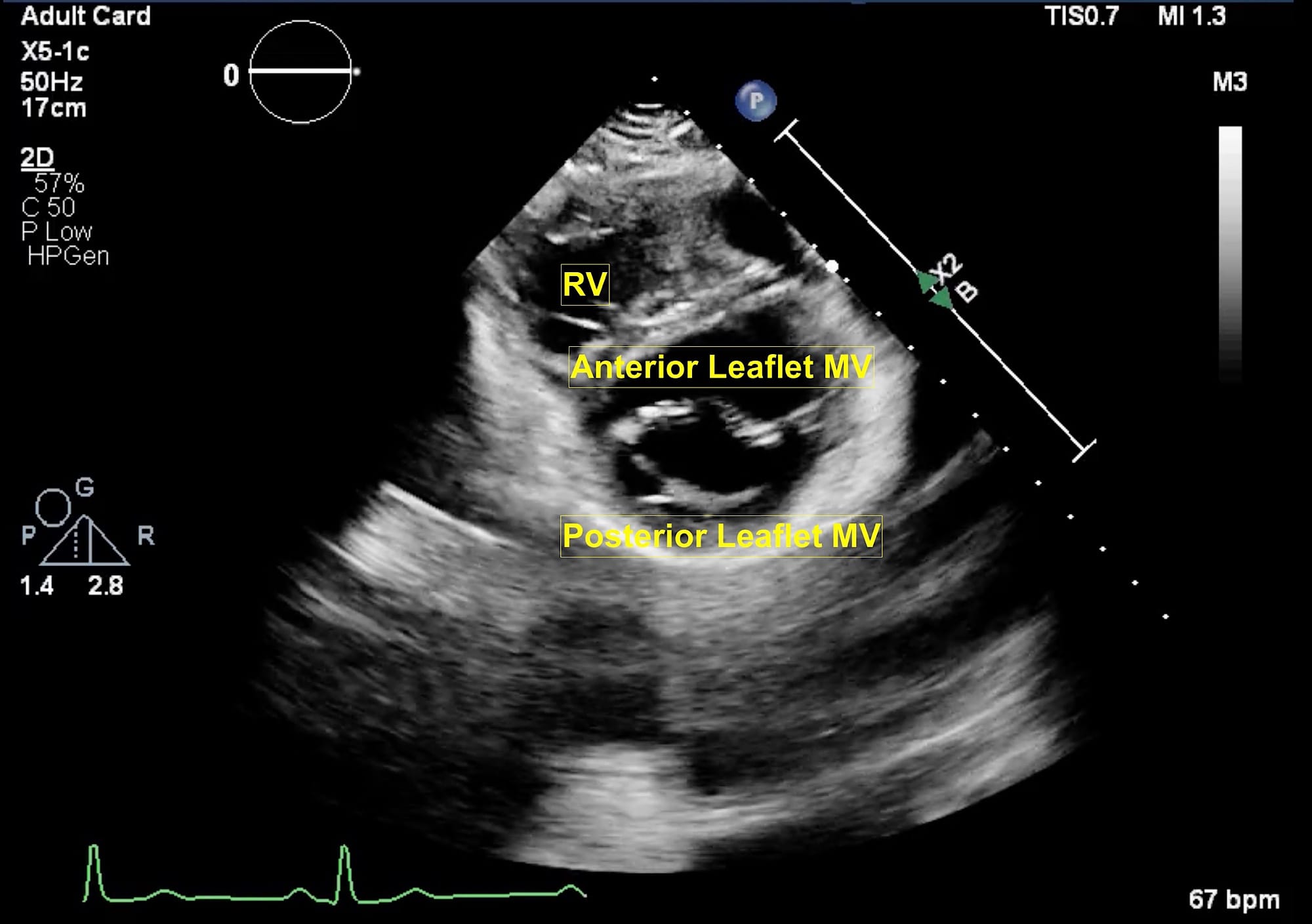 Figure 6 PSX MV
