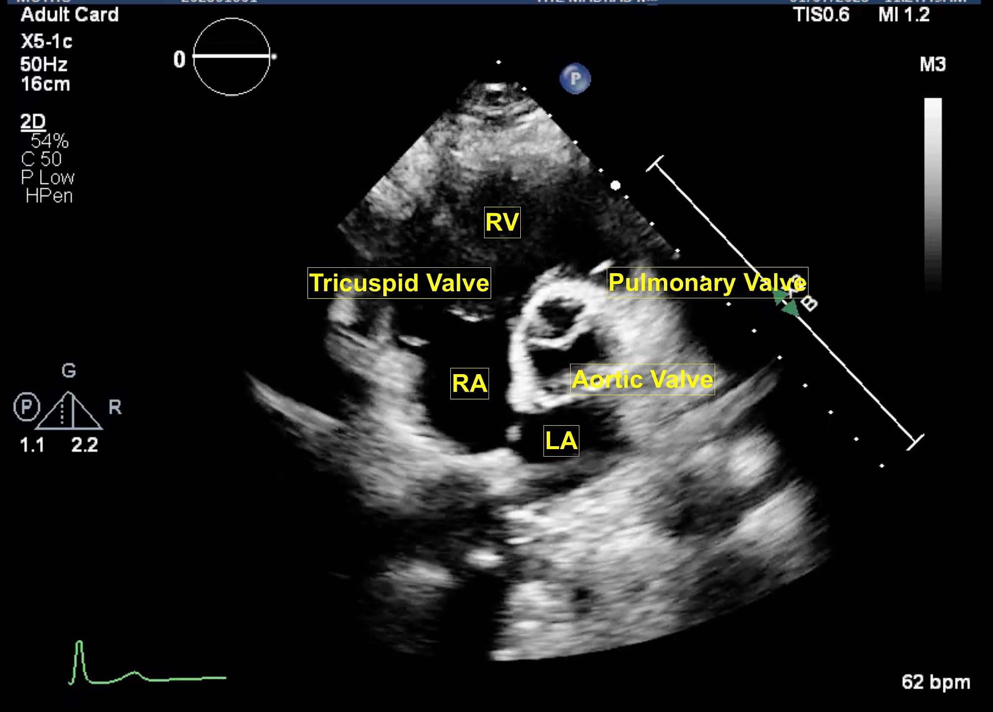 Figure 7 PSAX AV