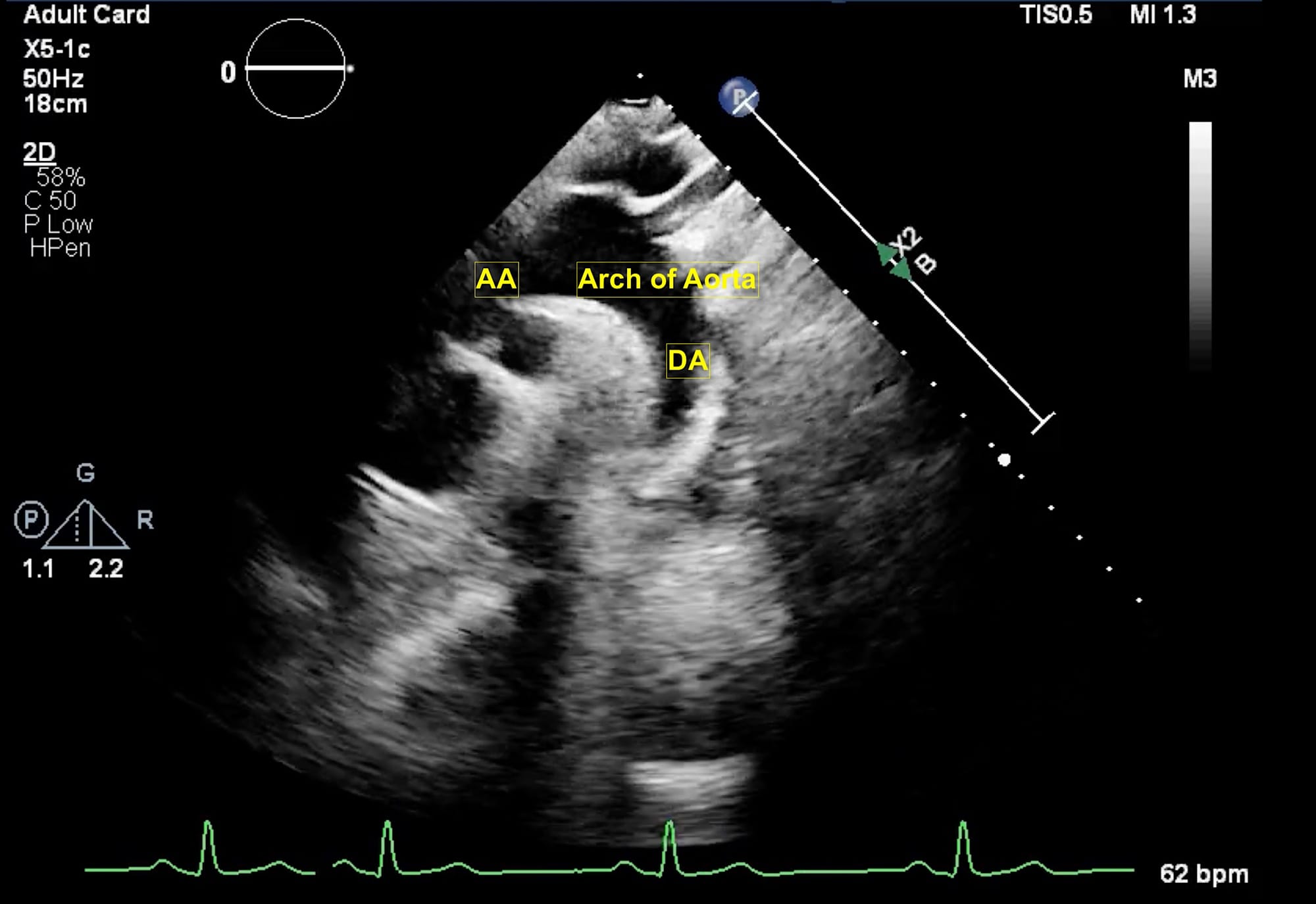 Figure 8 Suprasternal View