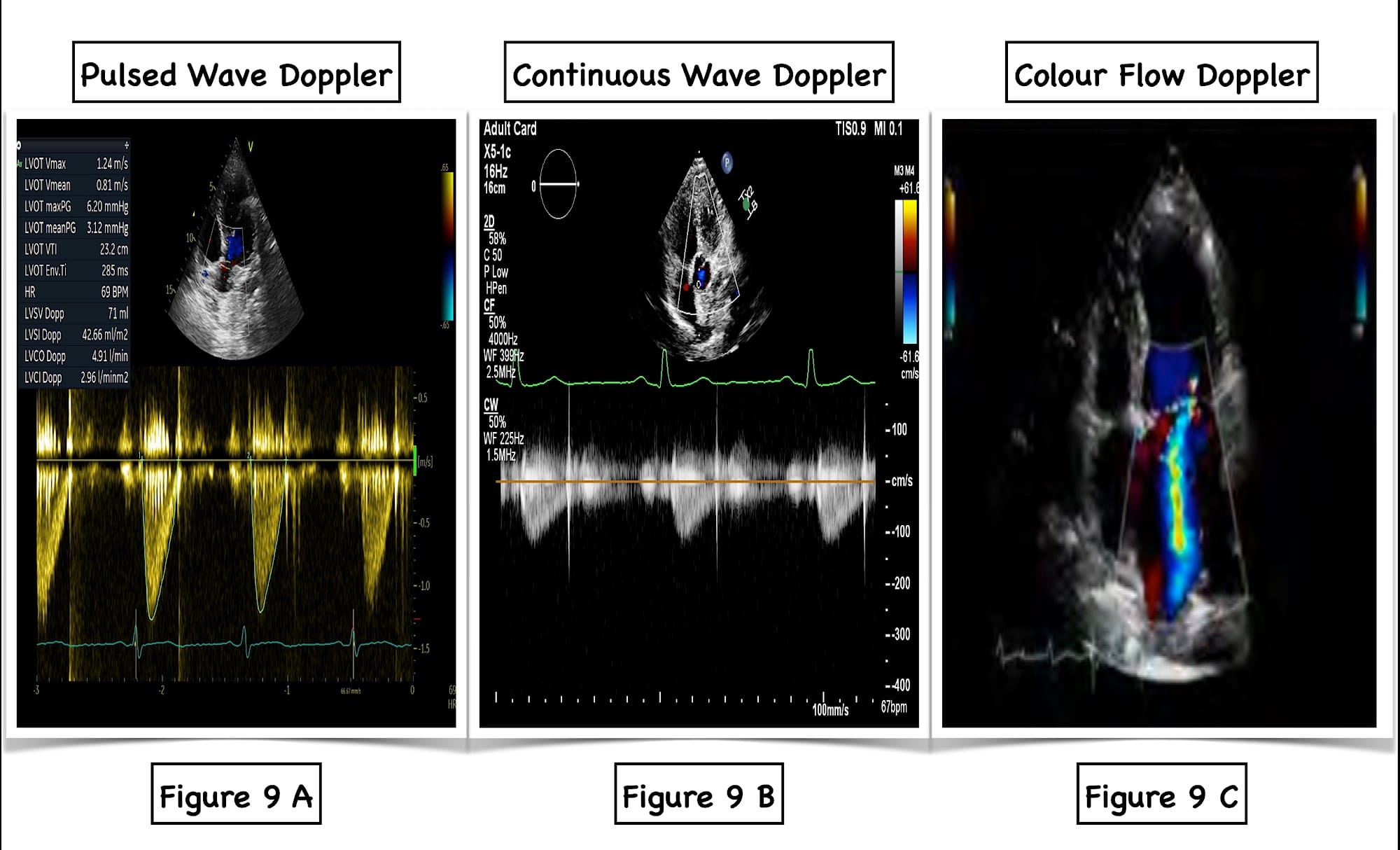 Figure 9 Various Doppler Modalities