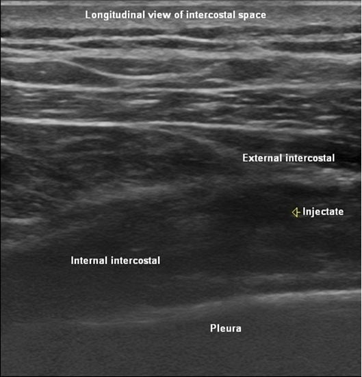 hariharan_longitudinal_sonographic_view_intercostal f2
