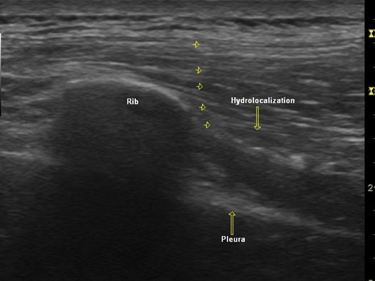 hariharan_parasgittal_sonogram_intercostal_block_f1
