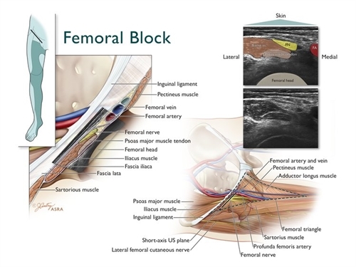 Femoral Block