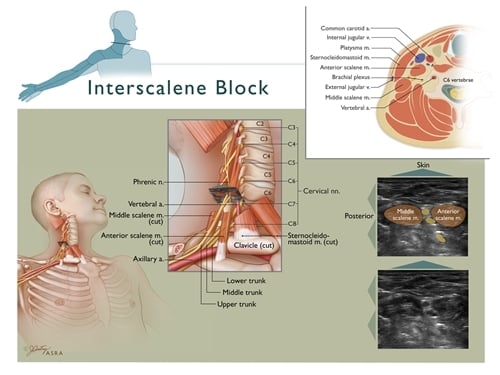 Interscalene Block