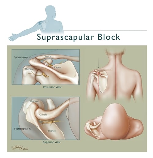 Suprascapular Block