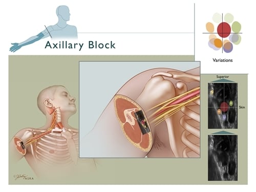 Axillary Block