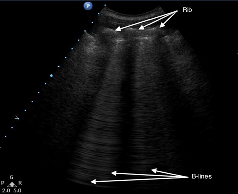 Manson_POCUS_Figure6_News022022
