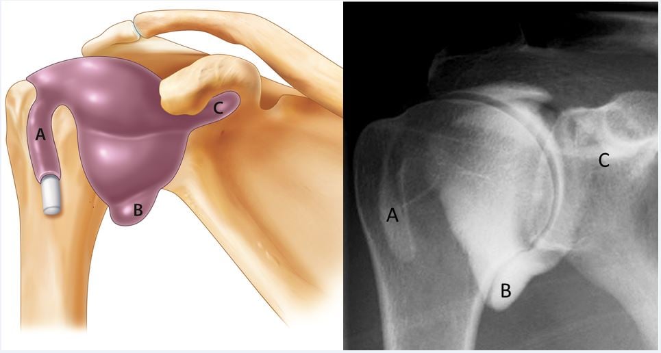 peng_2_ghj_recesses_uspm_shoulder