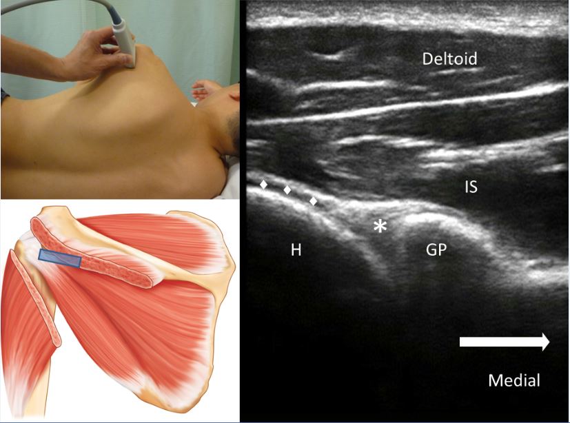peng_3_ghj_sonoanatomy_uspm_shoulder