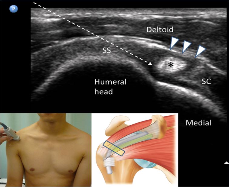 peng_4_rci_injection_uspm_shoulder