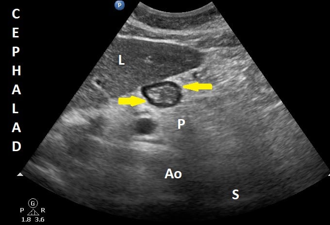 Pocus Gastric Figure 1 Nov 21