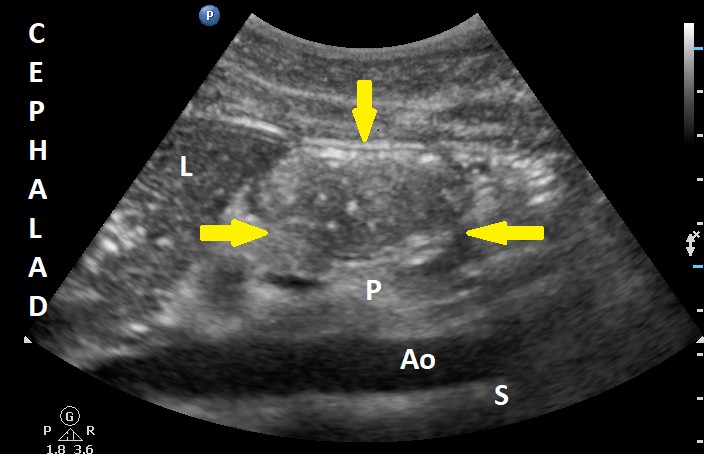 Pocus Gastric Figure 2 Nov 21