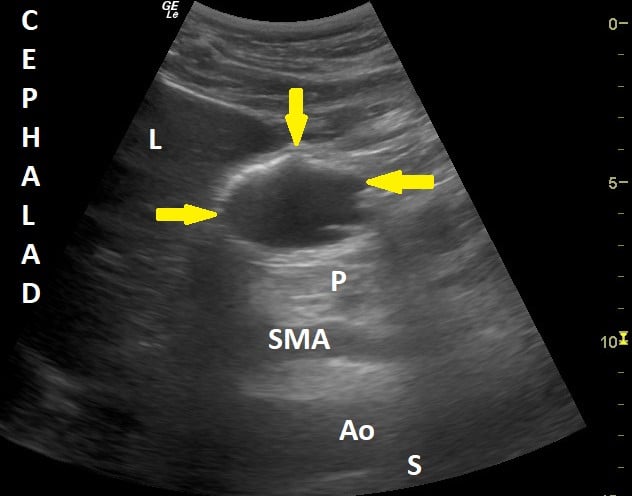 Pocus Gastric Figure 3 Nov 21