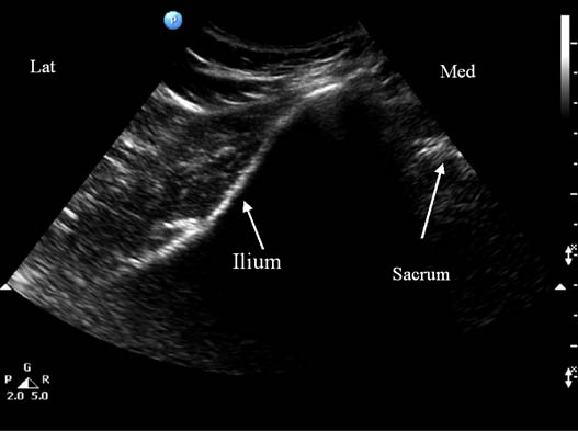 pudendal-nerve-injection-sonogram-showing-underlying-bony-structures