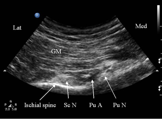 pudendal-nerve-injection-sonogram-showing-underlying-structures