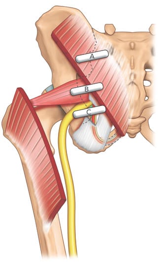 pudendal-nerve-injection-three-different-positions-of-the-ultrasound-transducer