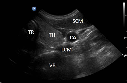 stellate-ganglion-block-a-low-frequency-curvilinear-transducer