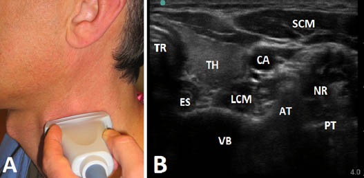 stellate-ganglion-block-anterolateral-aspect-of-the-_neck