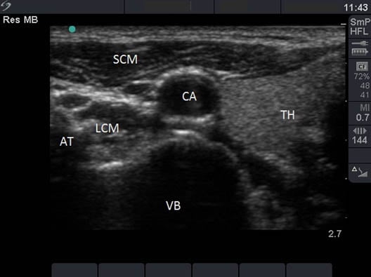 stellate-ganglion-block-anterolateral-neck-at-the-level-of-c6