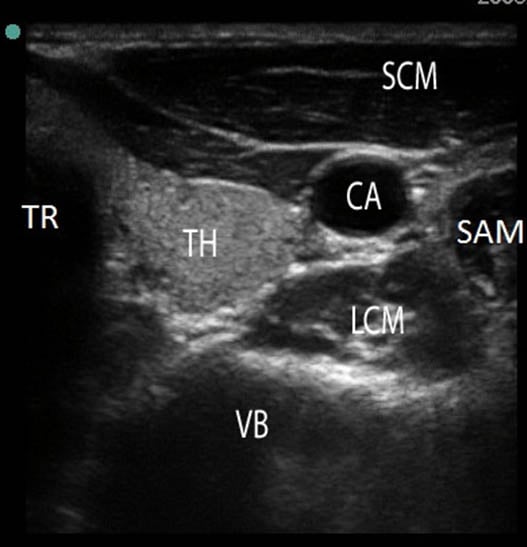stellate-ganglion-block-high-frequency-linear-transducer