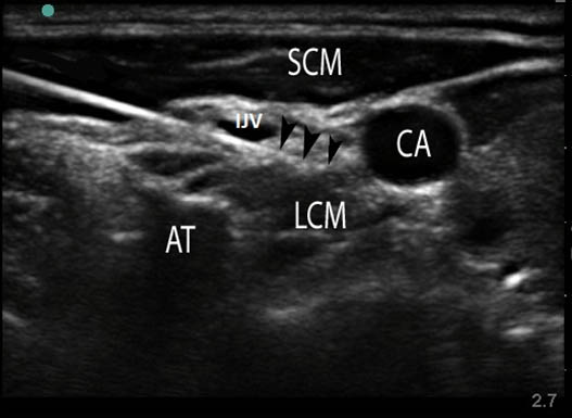 stellate-ganglion-block-sonogram-of-the-anterolateral-neck