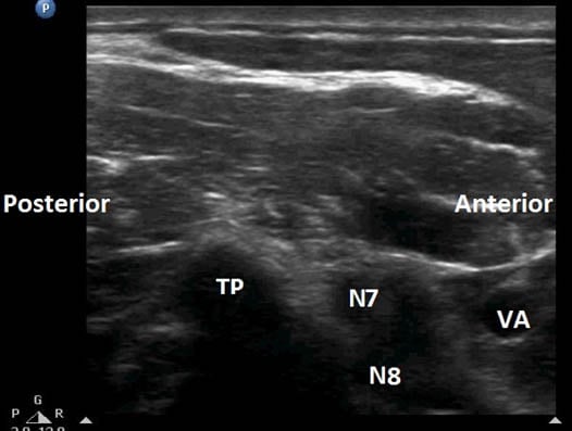 stellate-ganglion-block-transverse-sonogram
