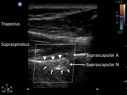 suprascapular-nerve-block-superior-suprascapular-nerve-in-the-suprascapular-notch