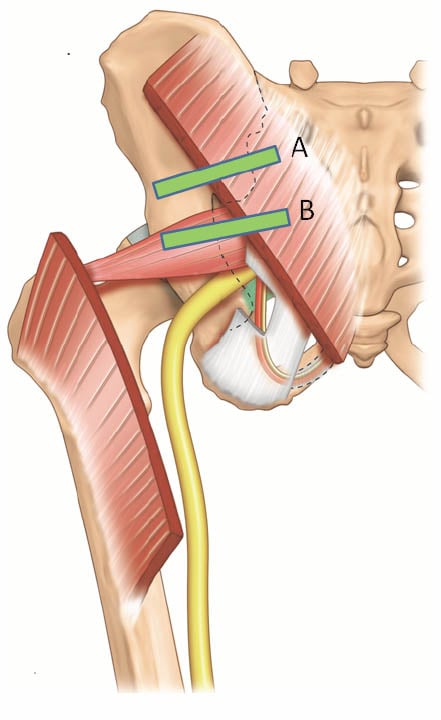 ultrasound-guided-block-for-peripheral-structures-piriformis-muscle-and-the-puden