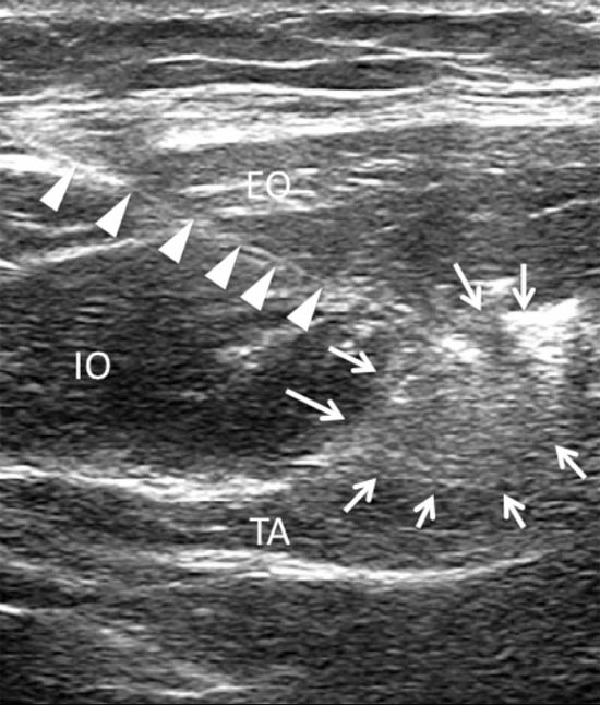 ultrasound-guided-block-for-peripheral-structures-spread-of-local-anesthetic-and-