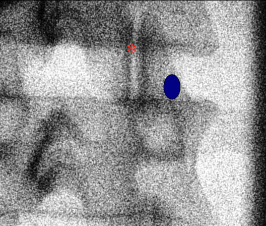 ultrasound-guided-lumbar-medial-branch-block-lumbar-facet-joint