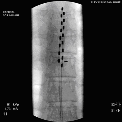 visceral-pain-electrical-leads