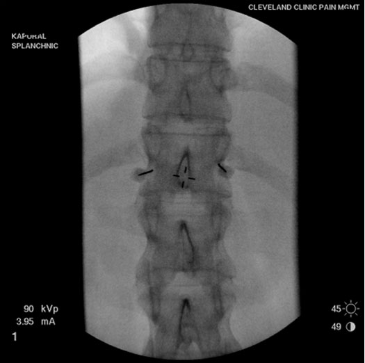 visceral-pain-for-bilateral-splanchnic-nerve-blocks