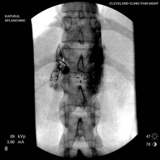 visceral-pain-injection-of-contrast-medium