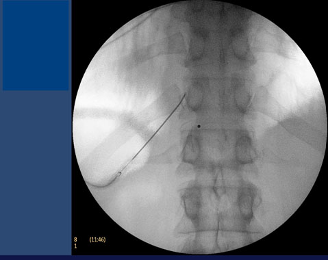 visceral-pain-radiofrequency-ablation-of-splanchnic-nerves
