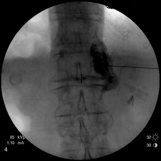 visceral-pain-right-celiac-plexus
