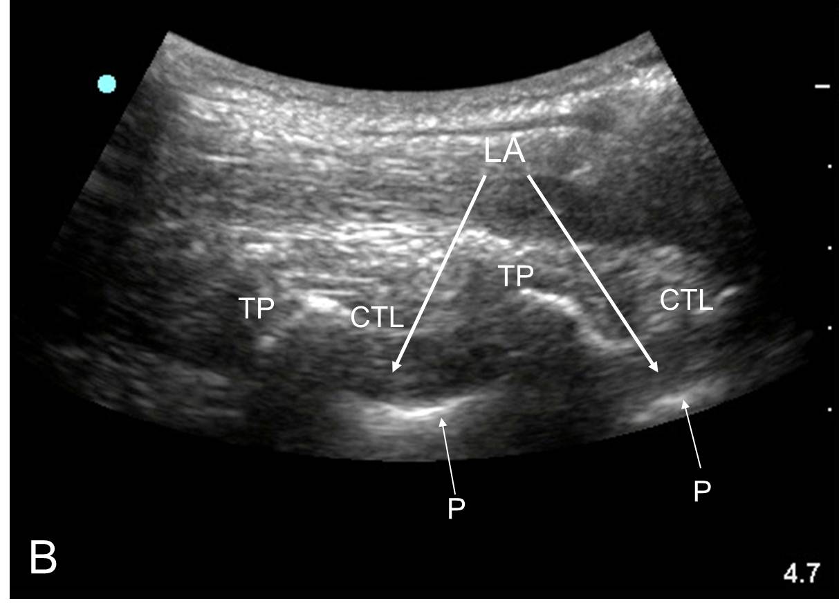 deposition of local anesthetic